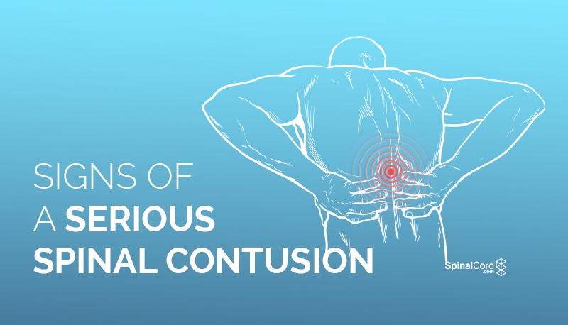 signs of a serious spinal contusion