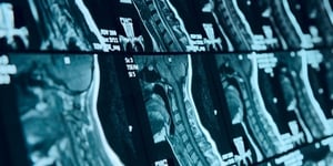 Spinal-Cord-Stroke-MRI-image