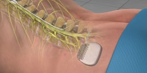 Spinal-cord-stimulator-concept-image