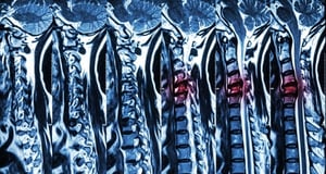 x-ray-image-of-the-cervical-spine