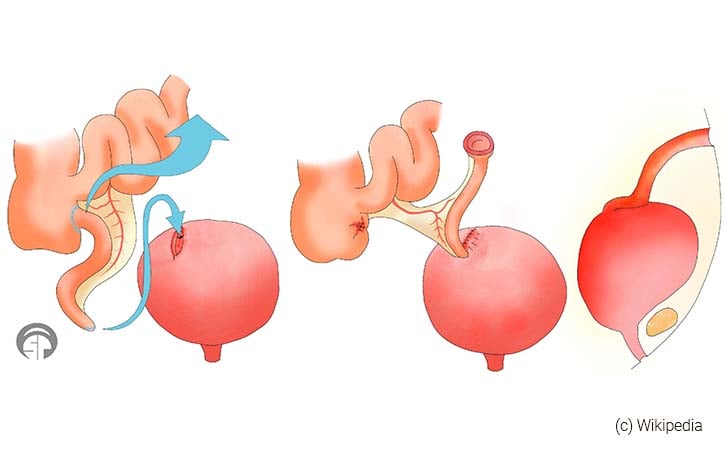 Mitrofanoff Procedure