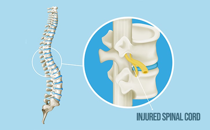 Spinal Cord Injury
