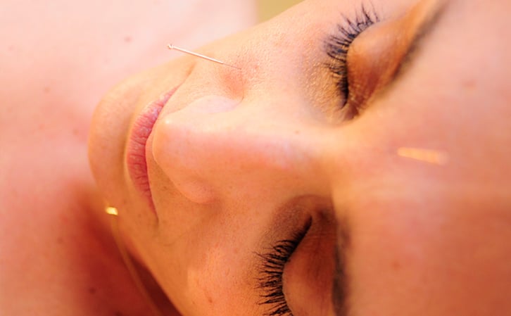 acupuncture in face