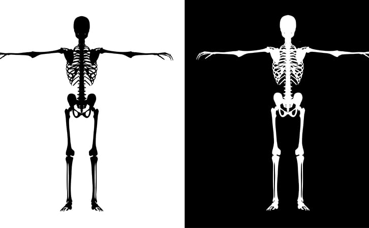 human bone - osteoporosis