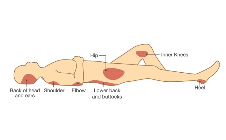 chart of pressure sore common locations