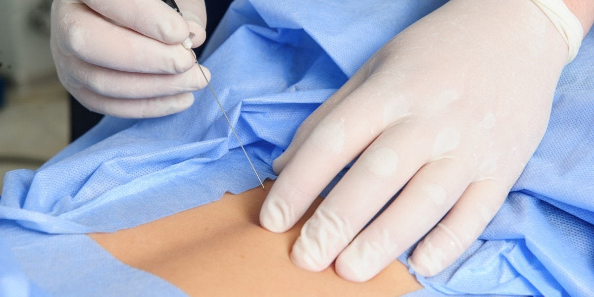 A Comprehensive Guide To Spinal Stimulator Surgery Arcadia ICO